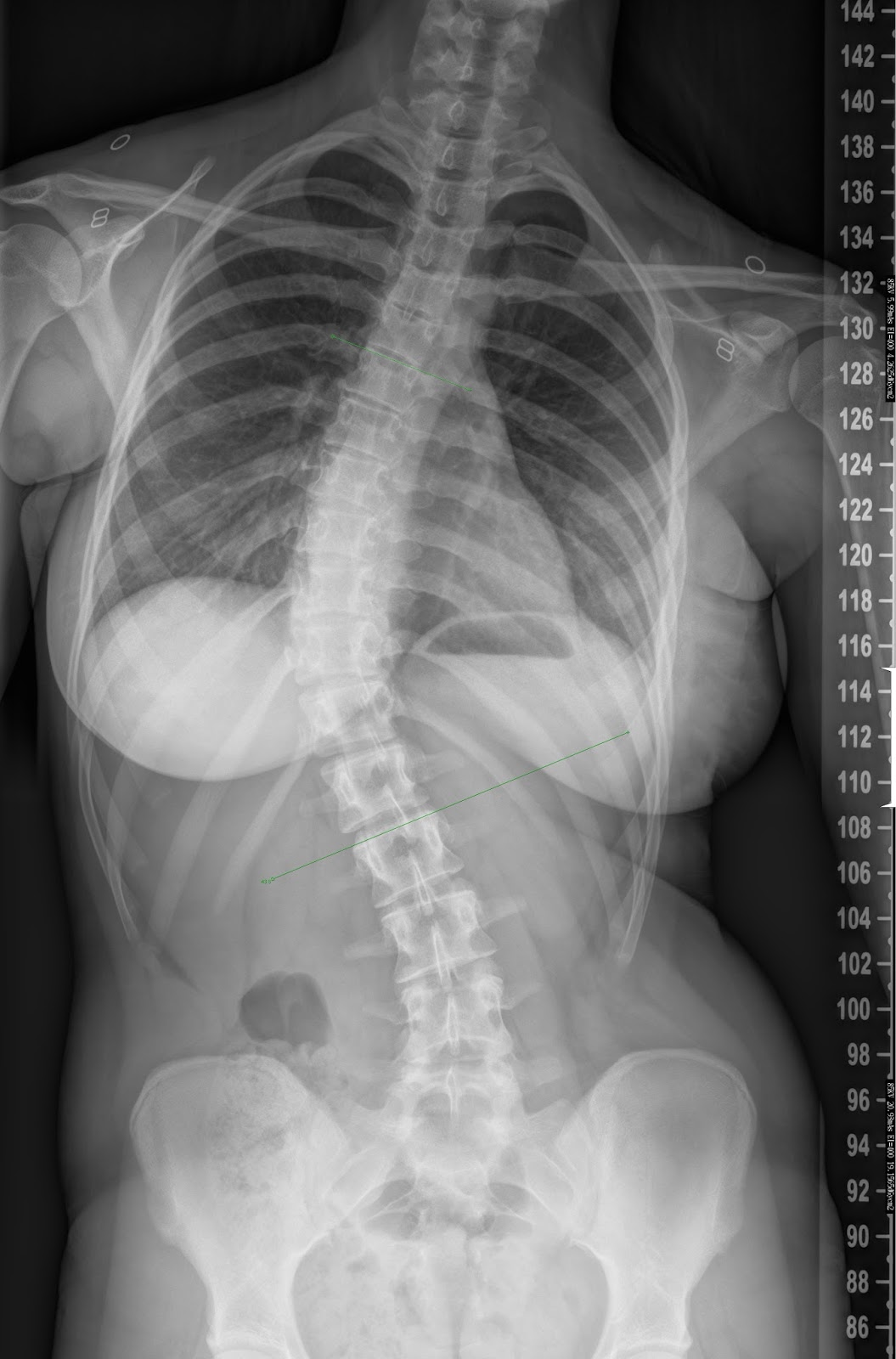 scolima: Meine Skoliose