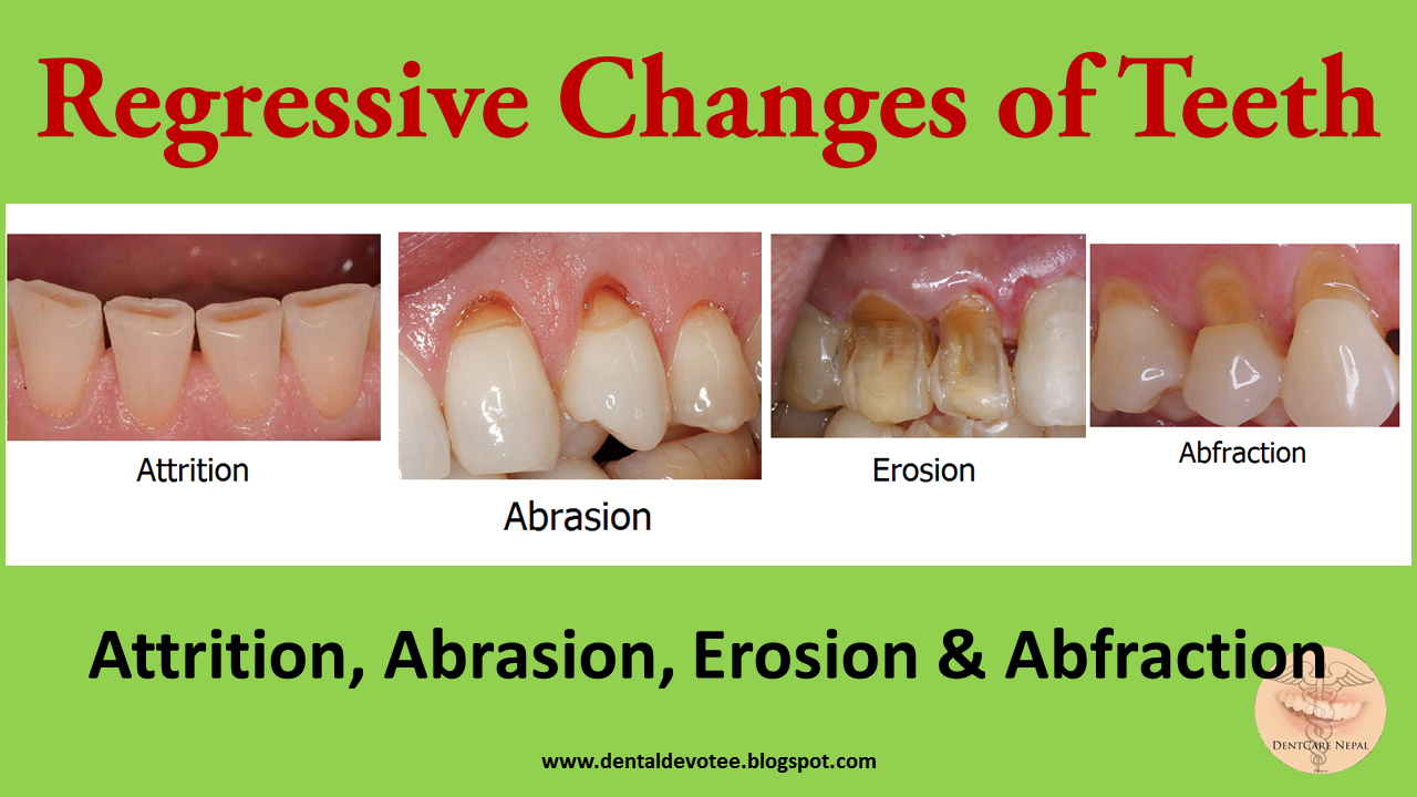 Dentosphere World of Dentistry Regressive changes in Tooth