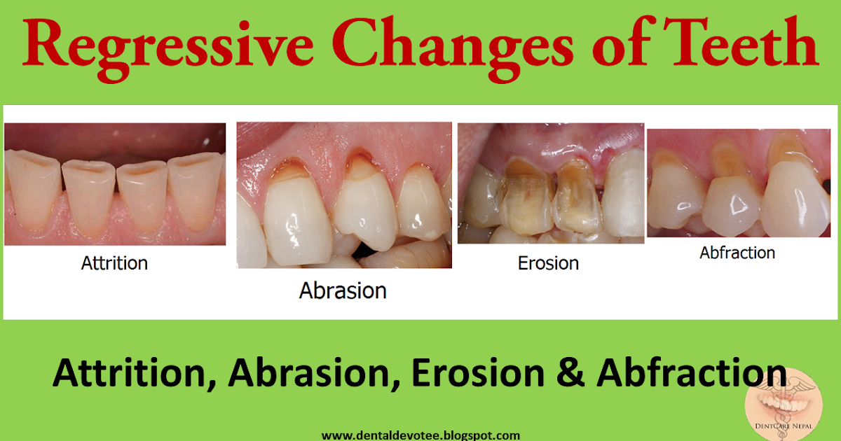 Dentosphere World of Dentistry Regressive changes in Tooth