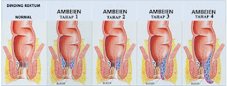 cara mengobati ambeien stadium 3