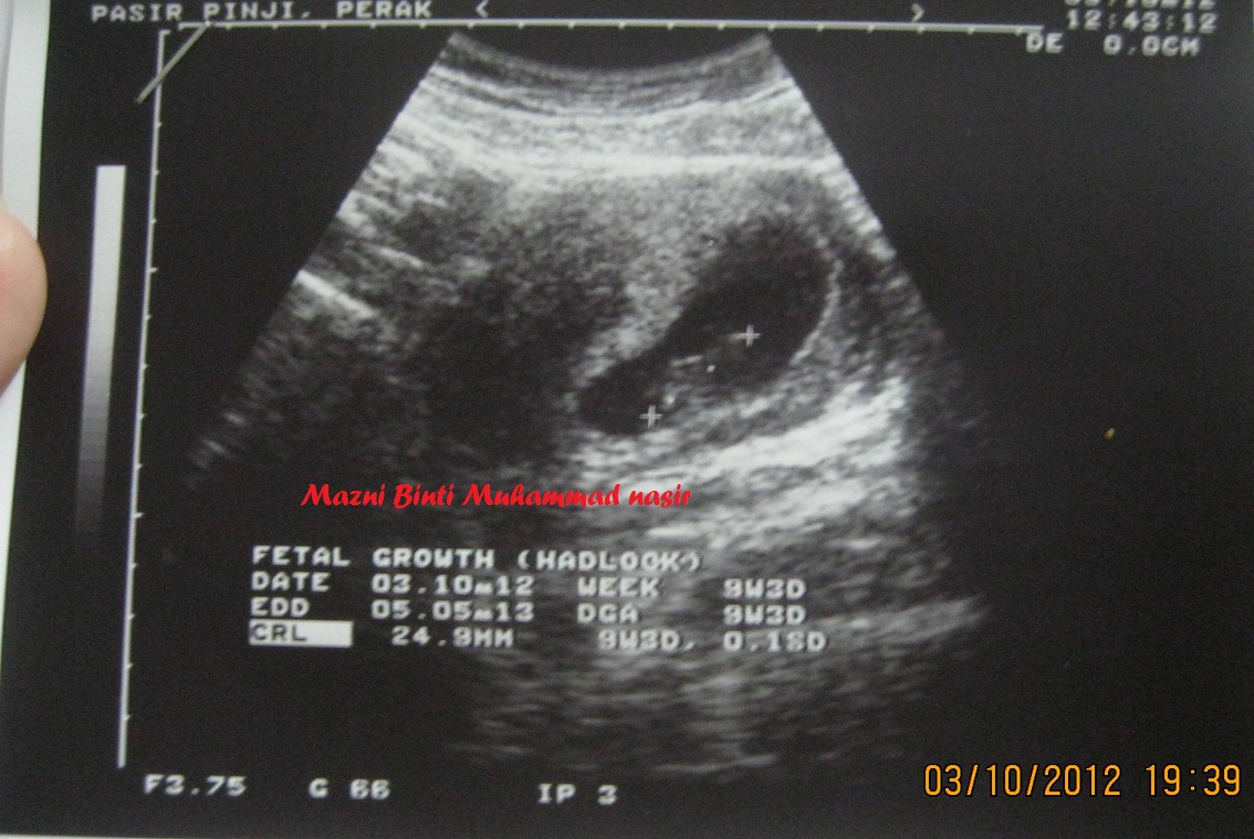 25 Minggu Berapa Bulan - usia kehamilan 12 minggu (hamil 3 bulan) - USG