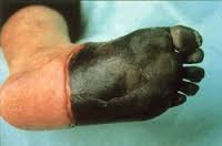 sintomas gangrena por diabetes tipo sintomas gangrena por diabetes tipo