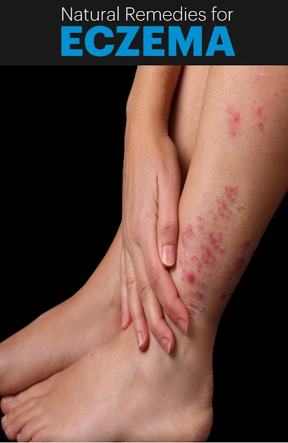 home remedies for eczema