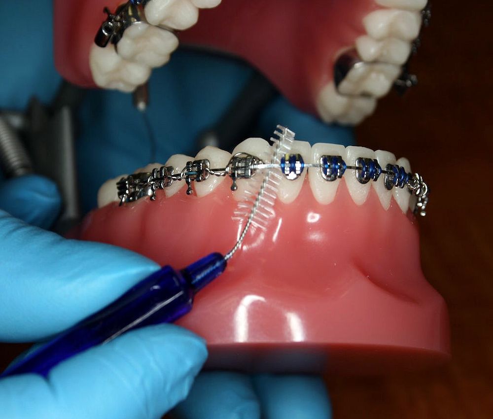 ORTHODONTICS Brushing with Braces Full Guide Directorio Odontológico