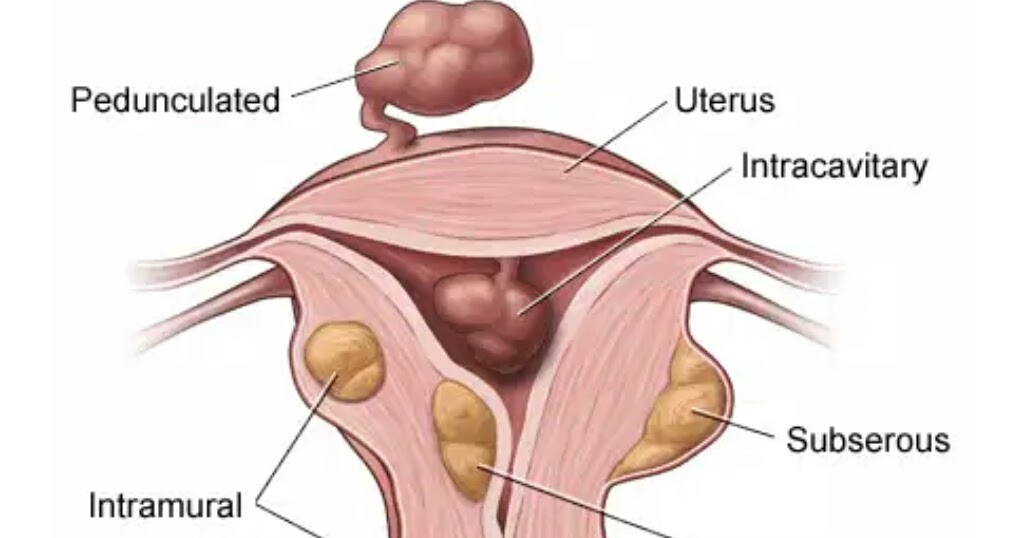 эко при миоме матки