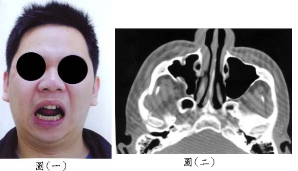 骨折 阿摩線上測驗