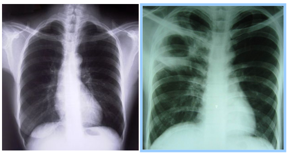 Bronkopneumonia Foto Thorax Normal Tb Paru Cavitas Gambar