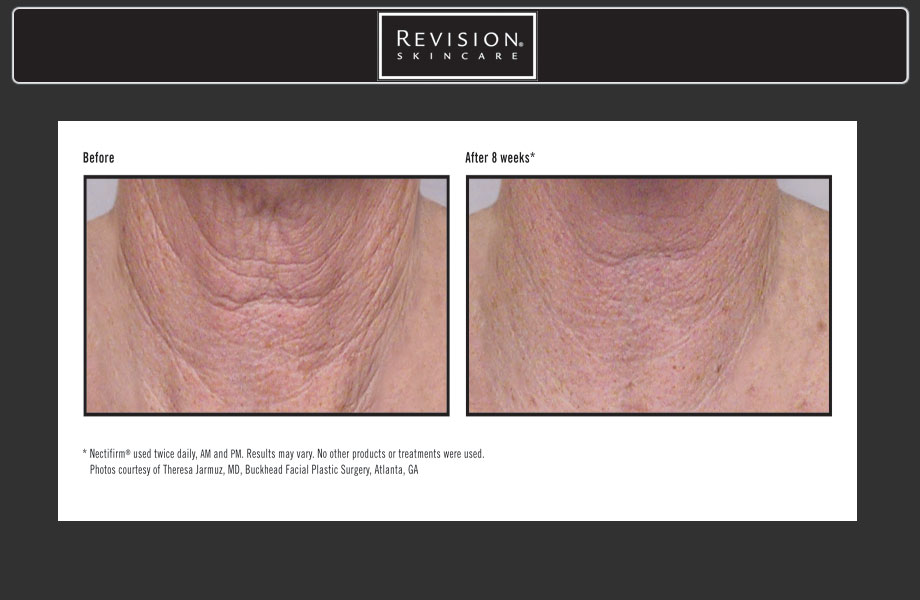 NECTIFIRM® The Advanced Technology for Firming the Neck