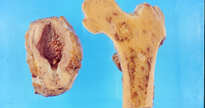 metastasi osseo per tumore alla prostata