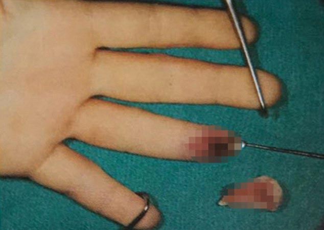 Se filtran fuertes imágenes del dedo de Lindsay Lohan antes de la operación Lindsay-lohan-foto-dedo-cortado-4.jpg.imgw.1280.1280