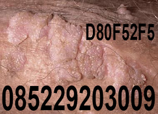 Obat Pengobatan Kutil Kelamin Herbal