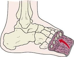 Transmetatarsal amputation Pictures.