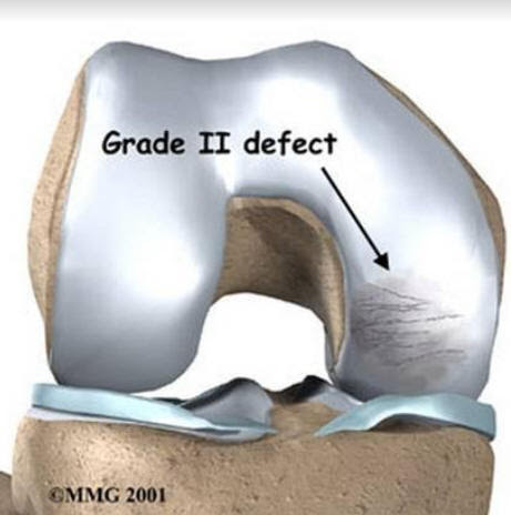 деформирующий остеоартроз поражение суставов. отслойка хряща мыщелка. поврежденный суставной хрящ. повреждение хряща. хондромаляция надколенника степени.