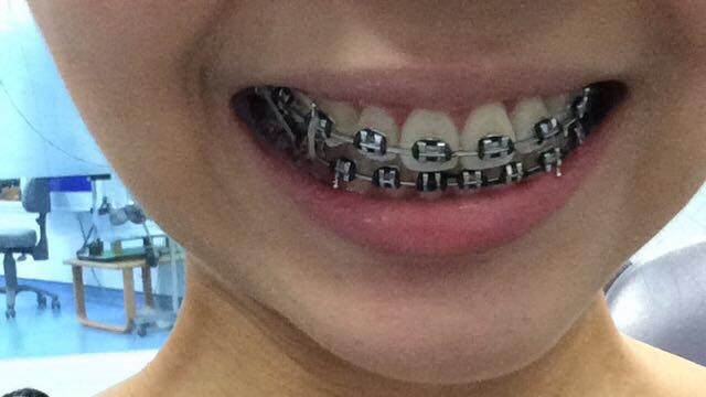 braces elastics journey chapter bite open totally loving