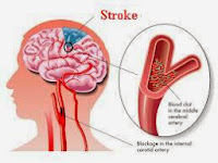 Cara Tradisional Mengobati Stroke Ringan dan Berat