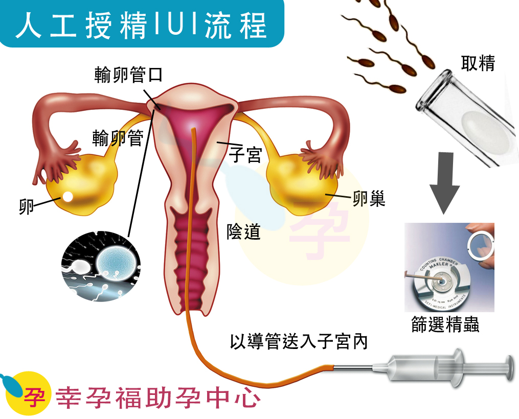 人工授精(Intrauterine insemination, IUI)是一種比較接近自然的受孕方式
