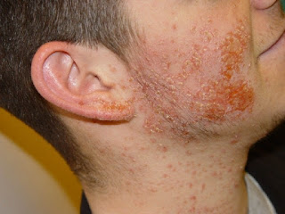 staph infection on neck