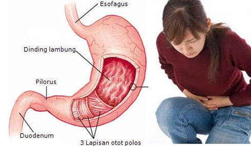 5 Cara Ampuh Atasi GERD Secara Alami: Raih Kembali Kesenangan Makan!