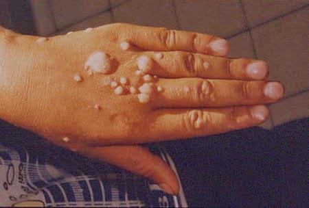 papilloma virus what is hpv