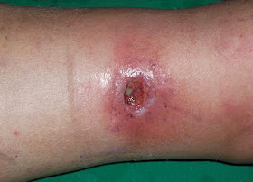 Ulcera varicosa