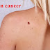 Skin cancer