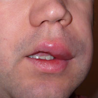 labios angioedema labios angioedema