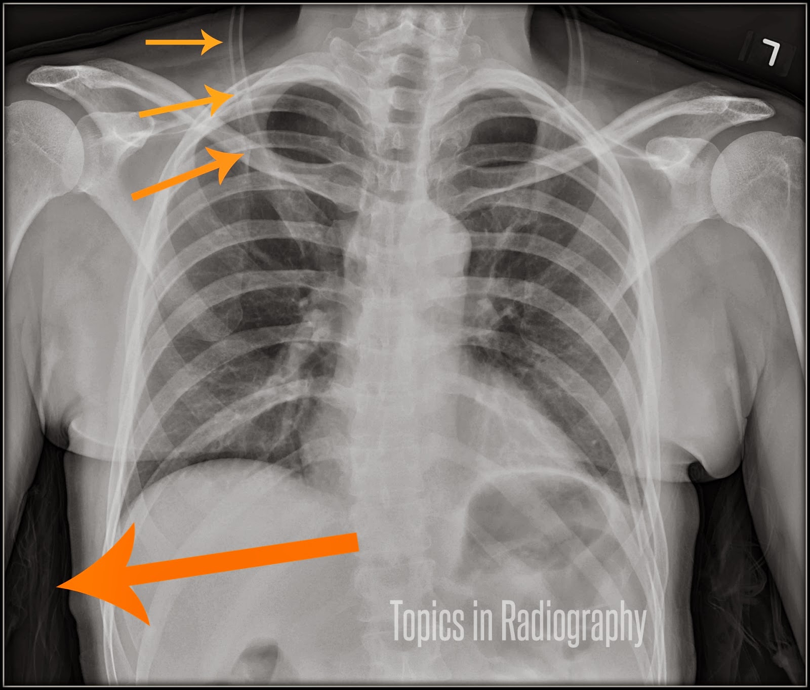 Topics in Radiography When to Remove Clothing for Xrays