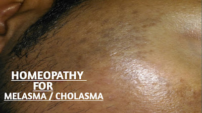 Homeopathy for Melasma , Cholasma