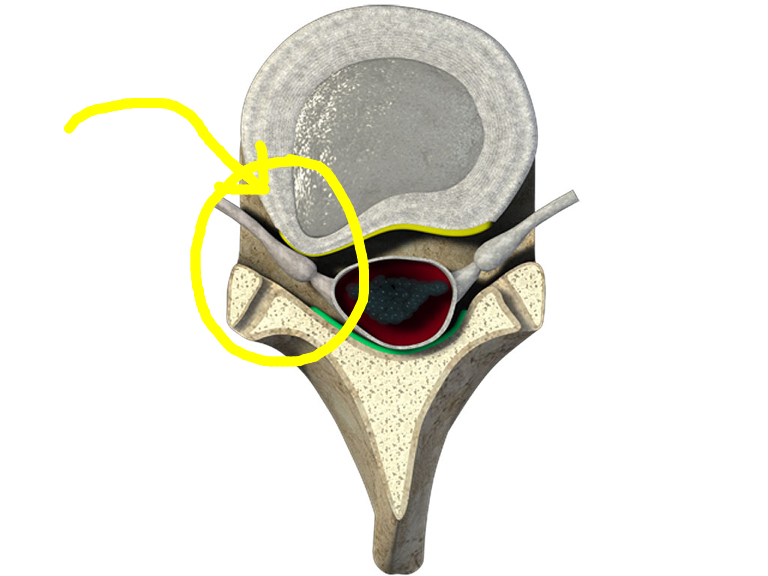 Herniated disc NYCSciatica NYCBack pain treatment Cervical disc