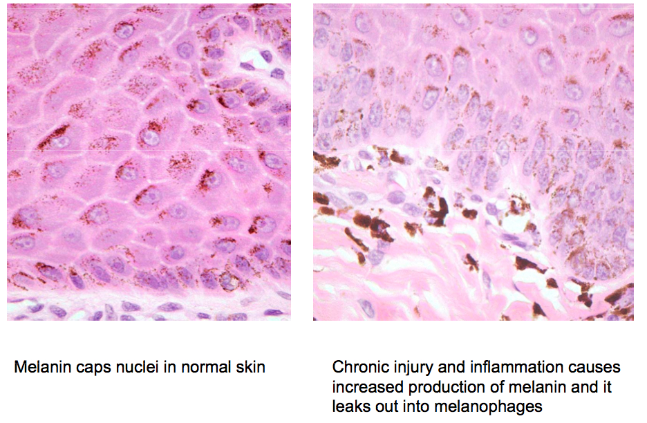 Пигмент меланин в каком слое. Меланоциты в коже гистология. Меланин клетка. Меланин под микроскопом.