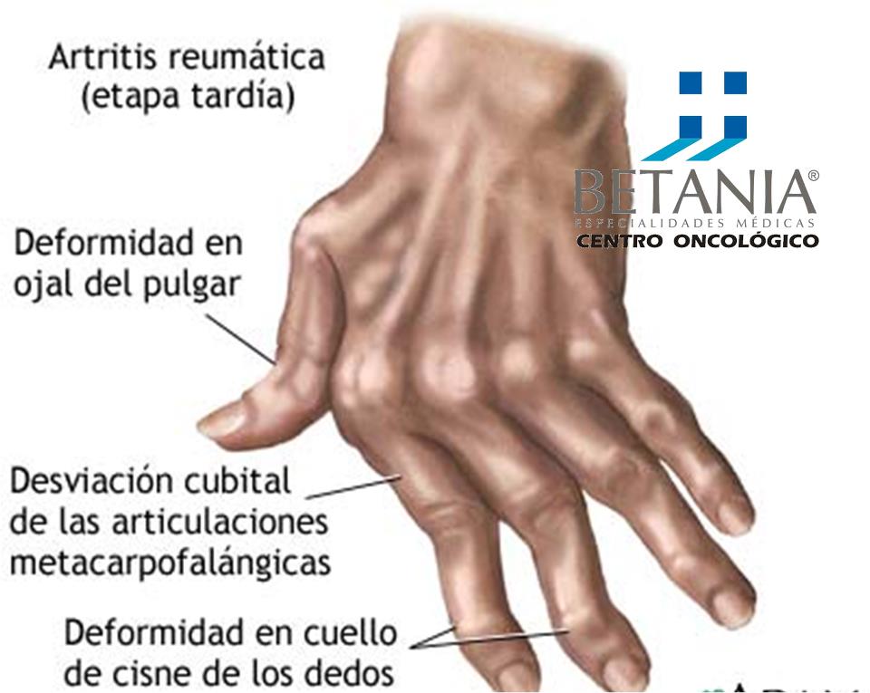 MEDICINA NATURAL Artritis reumatoidea MEDICINA NATURAL Artritis reumatoidea
