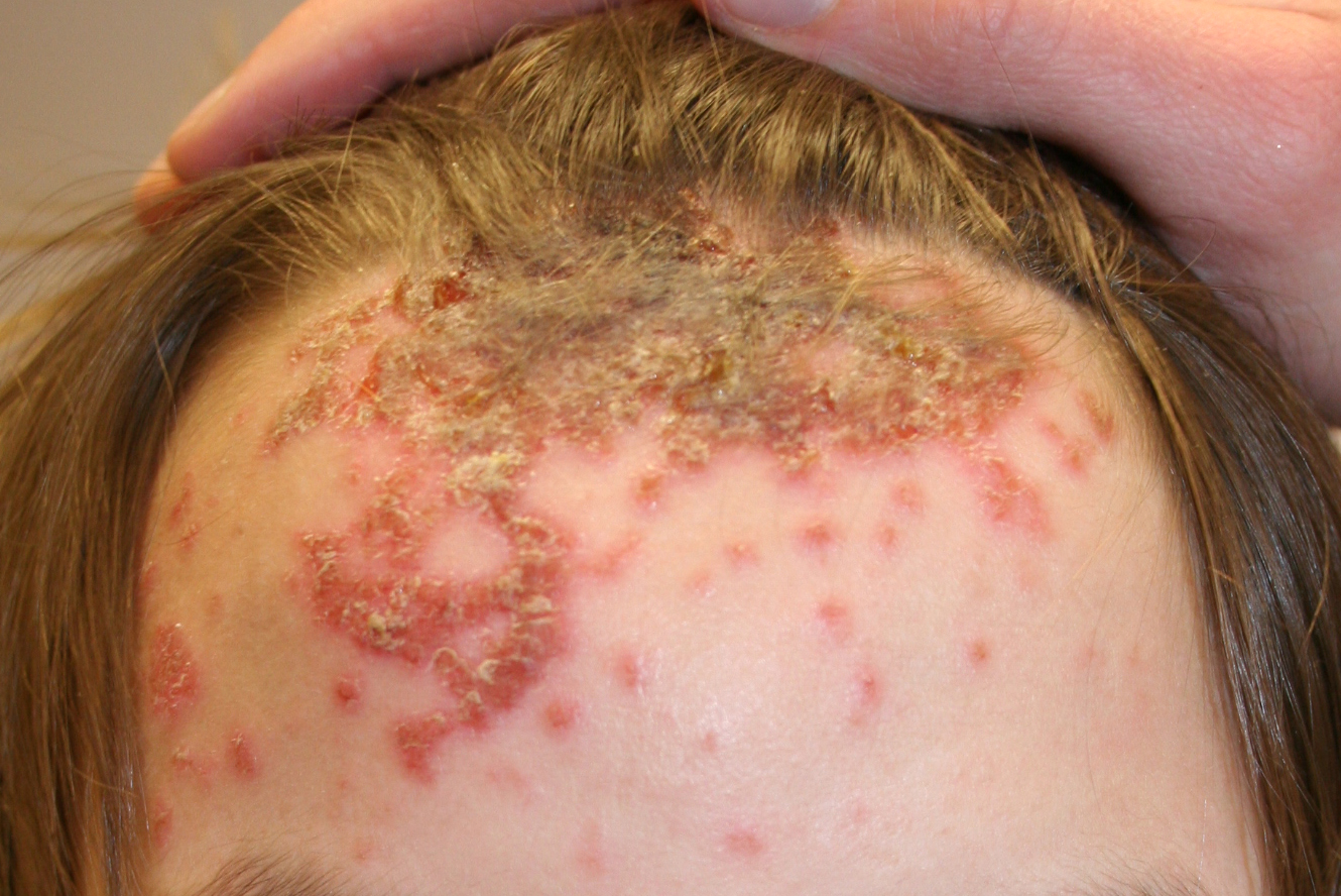 Impetigo Pictures, Images & Photos | Photobucket