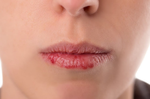Penyebab dan Cara Mengatasi Mulut Kering