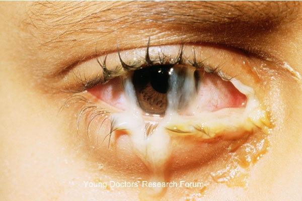 Viral Conjunctivitis – Symptoms, Duration, Causes and ...