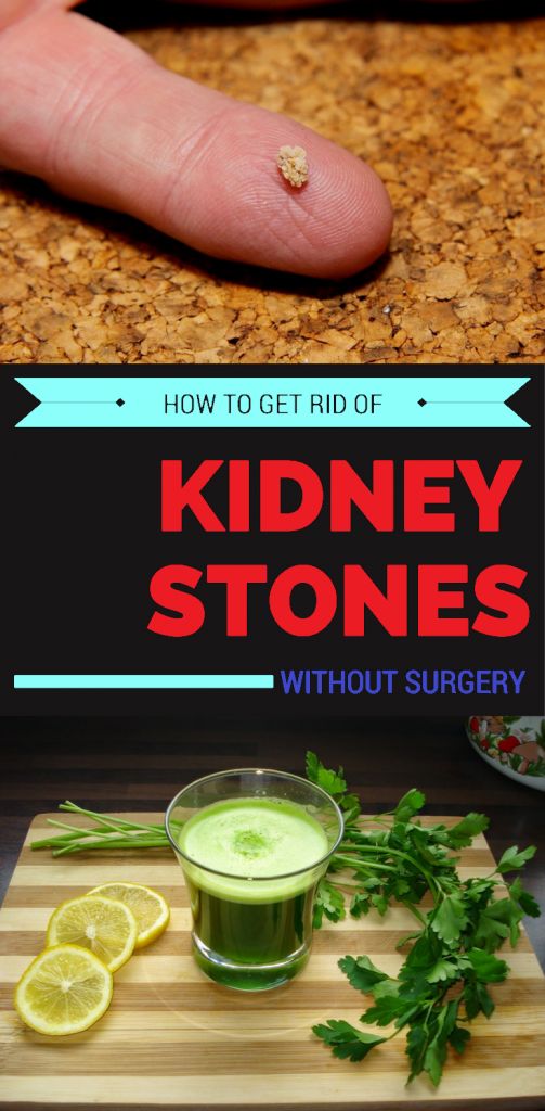EXPLORE HEALTH How To Get Rid Of Kidney Stones Without Surgery