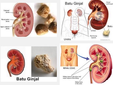 https://1.bp.blogspot.com/-Ww36JUlQHpc/WG657OWFxoI/AAAAAAAAAIM/u3MkPFr2BS0S2XDEsIET3VtysXh8aUAlACLcB/s1600/Batu-Ginjal-ampuh.jpg