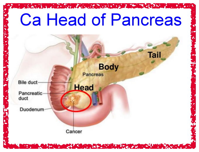 Ca head of pancreas