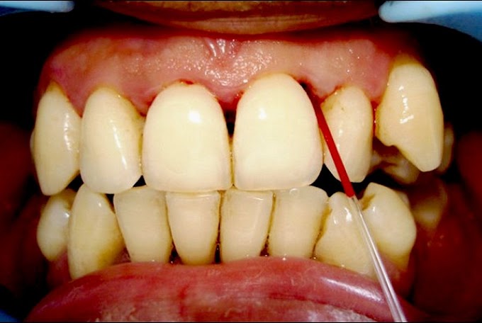 DIABETES: Screening for diabetes at dental visits using gingival crevicular blood (GCB)