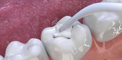 Vì sao răng sâu cần phải trám răng?