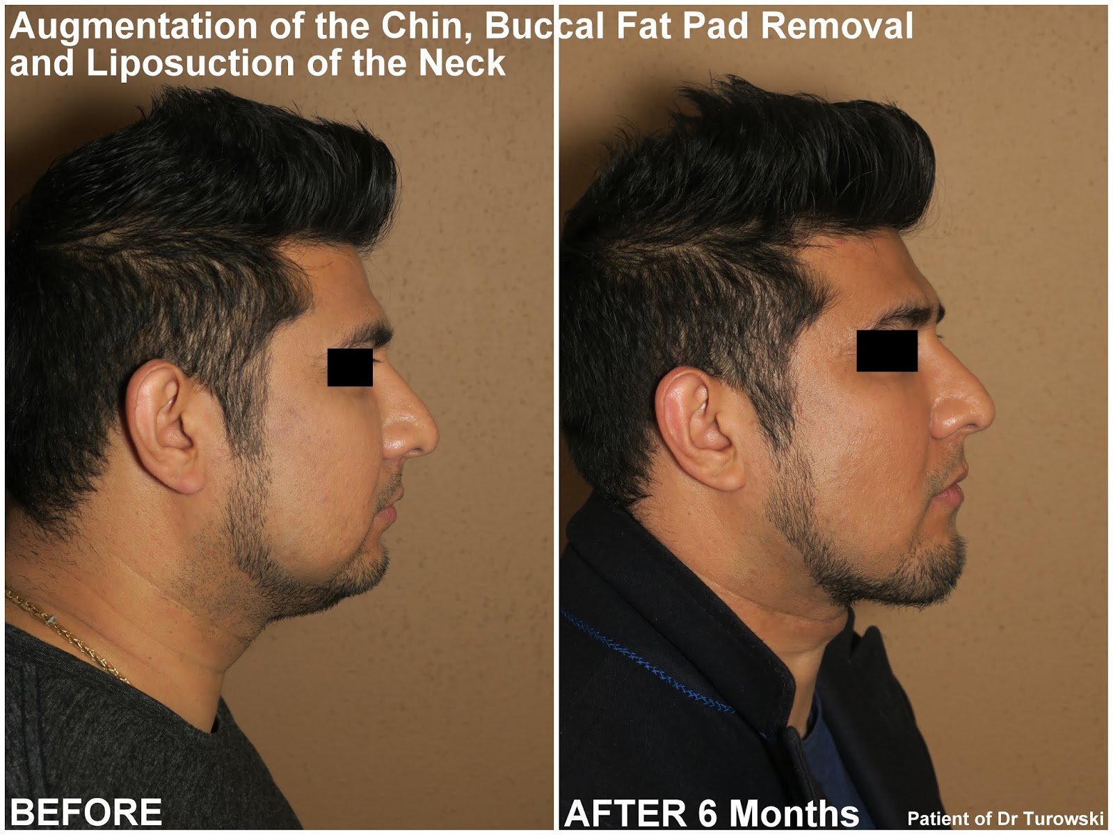 New Horizons Plastic Surgery Chin Augmentation, Buccal Fat Pad Removal