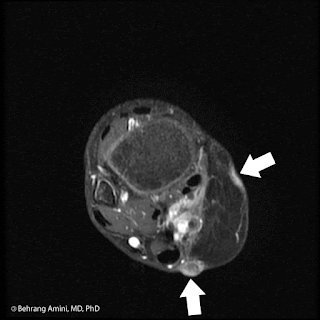 MRI in a patient with hypertrophic scar/keloid MRI in a patient with hypertrophic scar/keloid