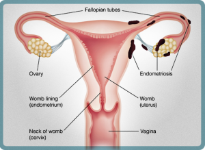 cara herbal mengatasi penyakit endometriosis