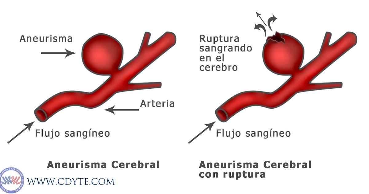 Patologías vasculares: Aneurismas