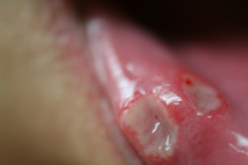 Pictures of Aphthous Ulcers of the Tongue and Palate ...