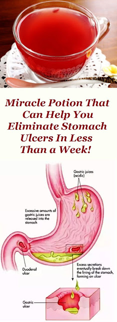 MIRACLE POTION THAT CAN HELP YOU ELIMINATE STOMACH ULCERS IN LESS THAN A WEEK!