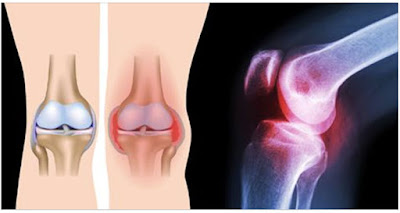 3 SIMPLE EXERCISES THAT HEAL KNEE PAIN WITHOUT SURGERY OR MEDICATION