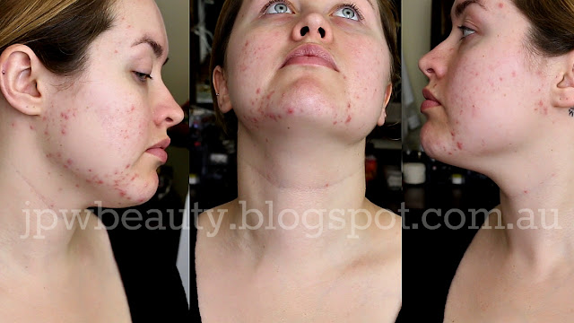 effaclar duo before after