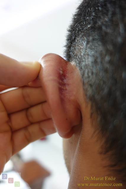 İple kepçe kulak ameliyatı - Mustarde Tekniği İle Kepçe Kulak Estetiği - Matris dikiş tekniği ile kepçe kulak düzeltilmesi