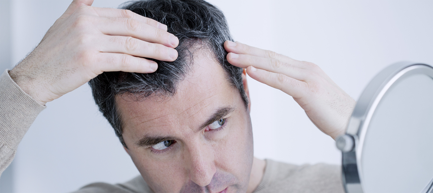 Top 9 Causes Of Male Hair Loss