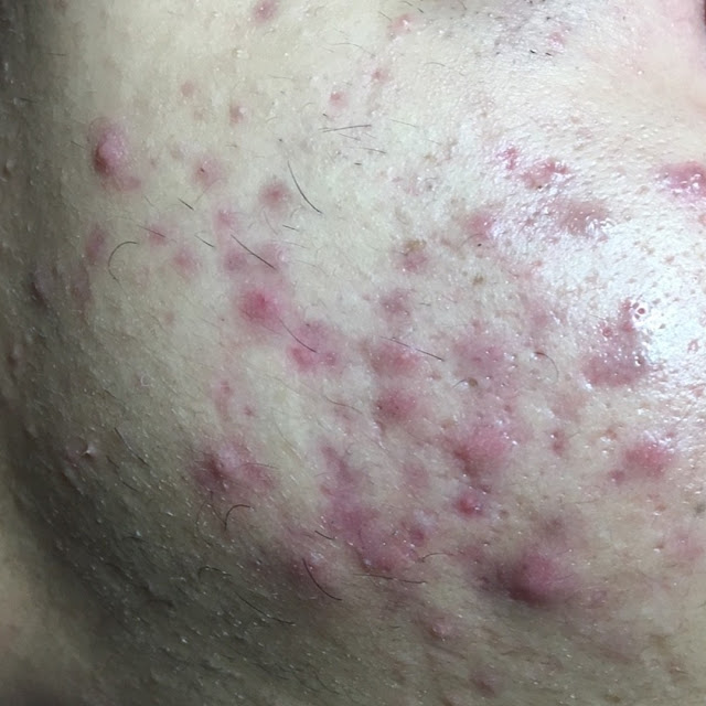顏之鑽高雄美容做臉清粉刺除痘痘護膚SPA,奎蒂絲杏仁酸精華液, 高雄左營岩盤浴推薦, 高雄全身去角質推薦, 高雄美容沙龍推薦, 高雄美容SPA推薦, 高雄做臉清粉刺推薦, 高雄WAXXXX熱蠟除毛推薦, 顏之鑽高雄美容做臉清粉刺除痘痘護膚SPA,高雄左營美容店,左營美容SPA護膚, 高雄左營做臉,高雄左營做臉推薦,高雄左營做臉分享,高雄左營做臉評價,高雄左營做臉價格, 高雄左營清粉刺,高雄左營清粉刺推薦,高雄左營清粉刺店家,高雄左營清粉刺推薦店家,高雄左營清粉刺價格, 高雄左營清粉刺評價,高雄左營清粉刺分享,高雄左營清粉刺便宜,高雄左營無痛清粉刺,高雄左營擠粉刺, 高雄左營美顏店推薦,高雄左營美顏店家, 高雄左營美容店推薦, 高雄左營熱蠟除毛,高雄左營熱蠟除毛便宜,高雄左營熱蠟除毛分享,高雄左營熱蠟除毛評價,高雄左營熱蠟除毛價格, 高雄左營熱蠟除毛推薦,高雄左營蜜蠟除毛評價,高雄左營蜜蠟除毛便宜,高雄左營蜜蠟除毛價格,高雄左營蜜蠟除毛推薦, 高雄左營腋下除毛評價,高雄左營腋下除毛推薦,高雄左營腋下除毛價格,高雄左營腋下除毛分享,高雄左營腋下除毛便宜, 高雄左營私密處除毛評價,高雄左營私密處除毛推薦,高雄左營私密處除毛價格,高雄左營私密處除毛便宜, 高雄左營岩盤浴SPA,高雄左營岩盤浴,高雄左營岩盤浴推薦,岩盤浴高雄左營